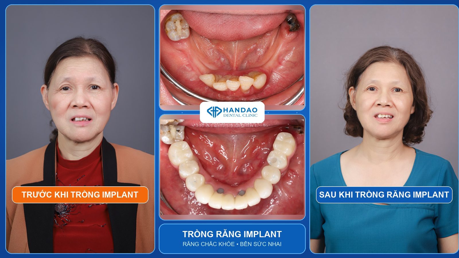 Cô Hoàng Thị Bình - ca trồng răng Implant toàn hàm thật tại Nha khoa Hân Đào, hình ảnh trước và sau