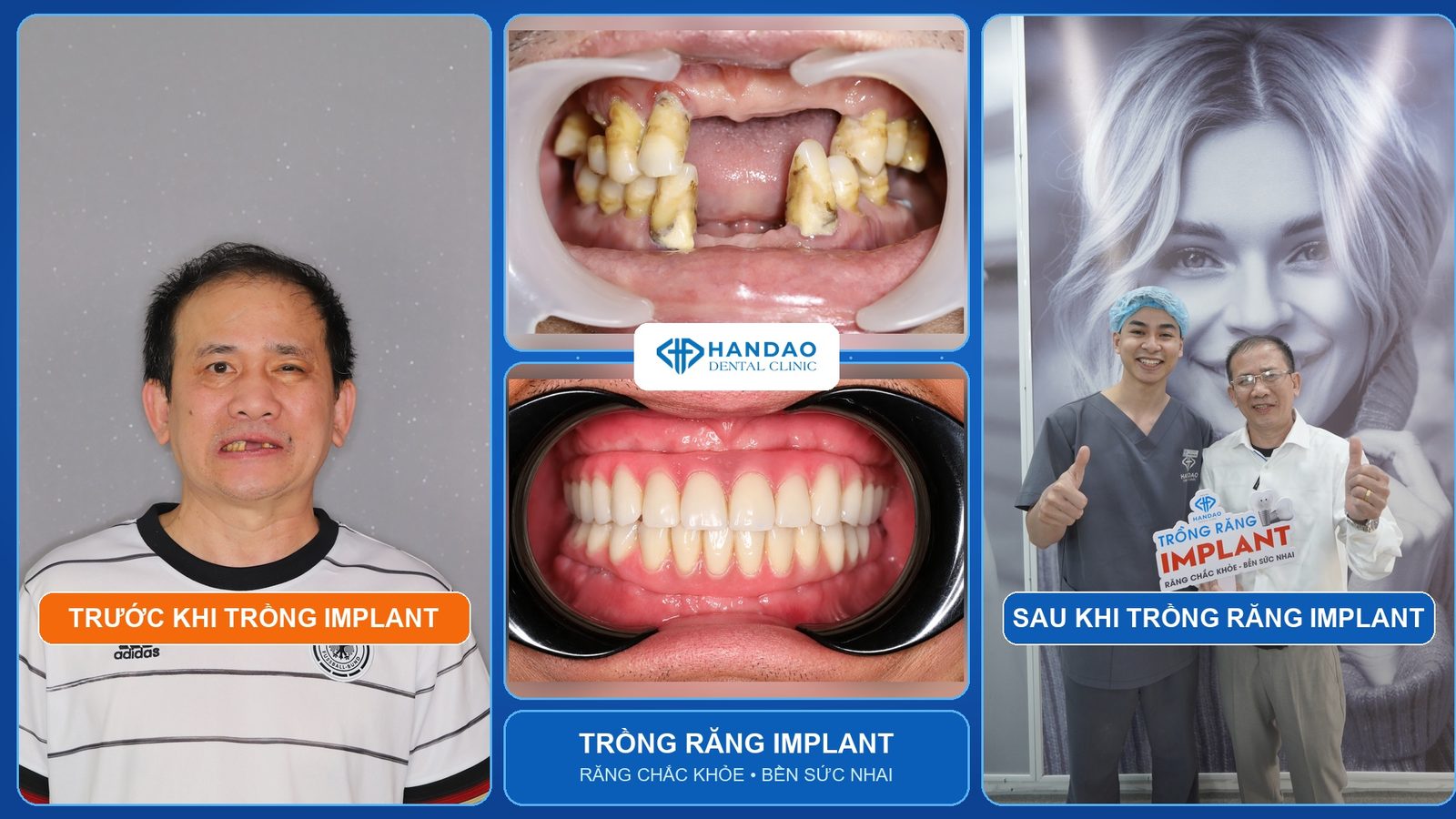 Chú Bùi Văn Lương - ca trồng răng Implant thật tại Nha khoa Hân Đào, hình ảnh trước và sau