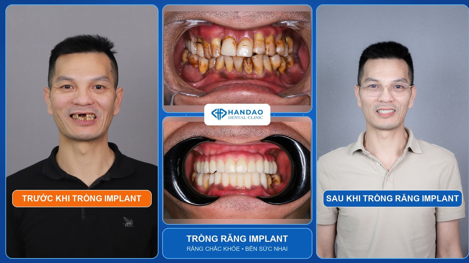 Anh Nguyễn Xuân Hoa - ca trồng răng Implant thật tại Nha khoa Hân Đào, hình ảnh trước và sau